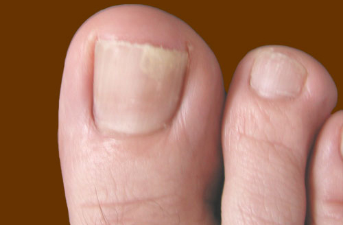 Как лечить грибок на ногтях